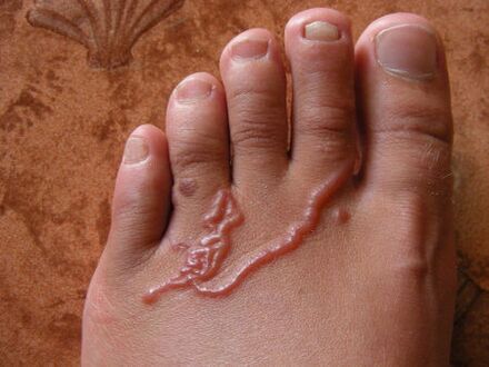Types de parasites