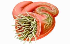 Comment nettoyer l'intestin des parasites