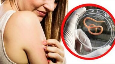 Une éruption cutanée sur le corps est le signe d'une infection helminthique